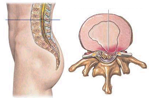 hernia de disco lombar