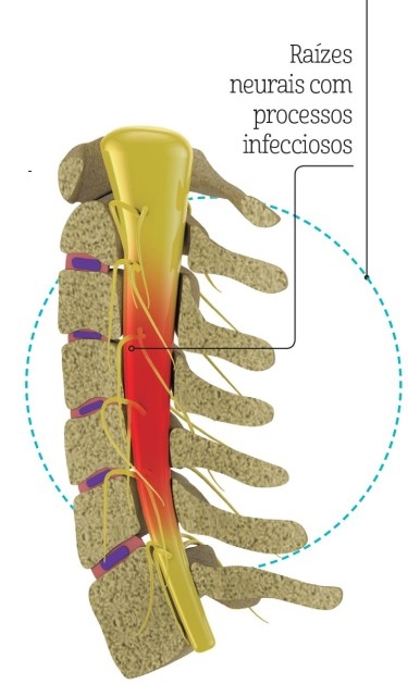 mielopatia-tratamento-itc-vertebral